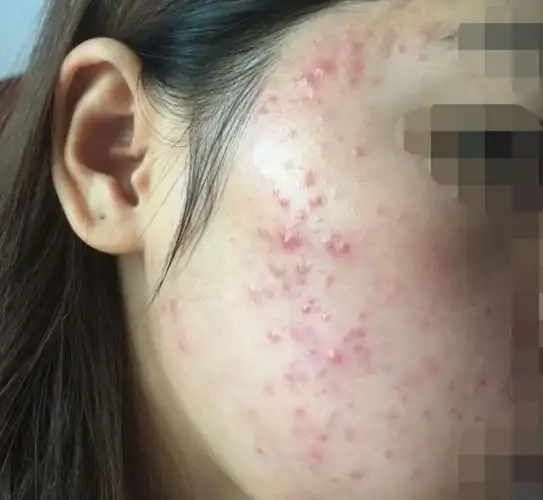 皮肤科董医生:夏季护肤,痘痘肌小仙女们选对护肤品了吗?