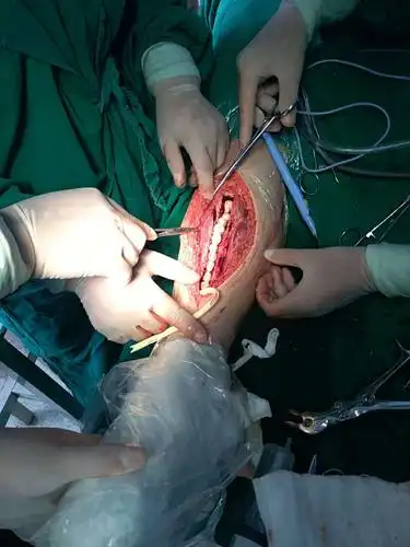 保山昌宁县医院骨科医师团队采用新方法开展对骨髓炎患者的治疗