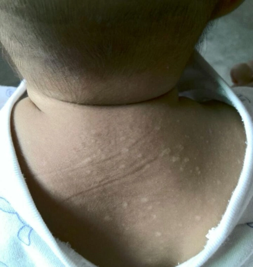 炎炎夏日花斑癣如何防治