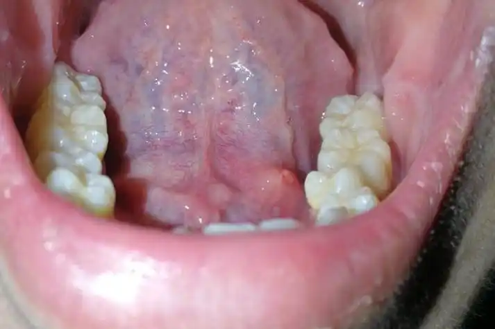 舌头系带两侧长小肉芽图片