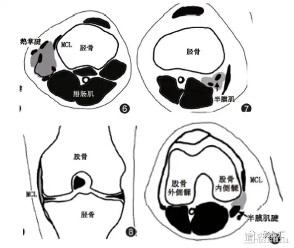 膝关节周围滑膜囊解剖相关文献学习(思维导图)