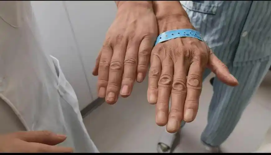 10年内3次命悬一线蜘蛛手女子三次手术终脱险