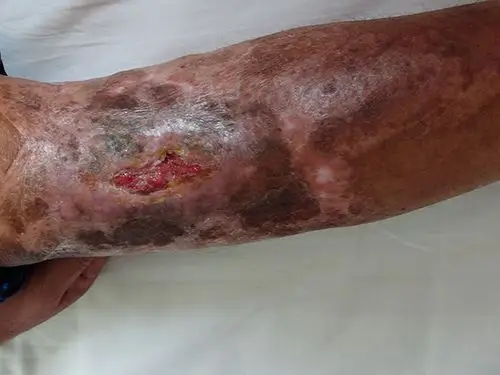 急性骨髓炎的危害性要大些,常见症状是发病急突然,有时无诱因,而患者