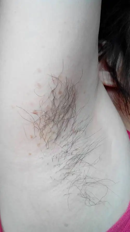 为什么腋下会长斑,而且有些痒,颜色有时深,有时浅.