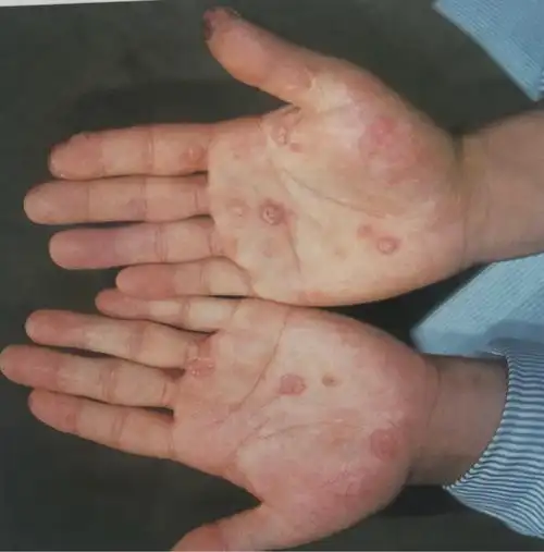 皮肤性病之梅毒