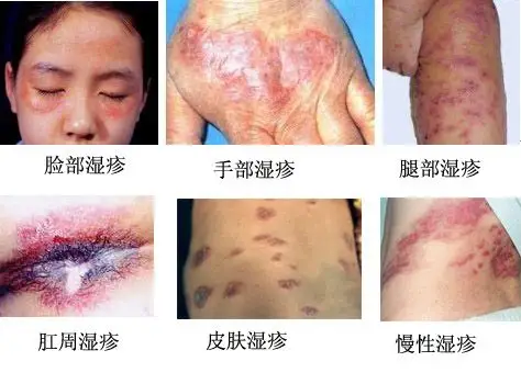 湿疹的症状图片及治疗