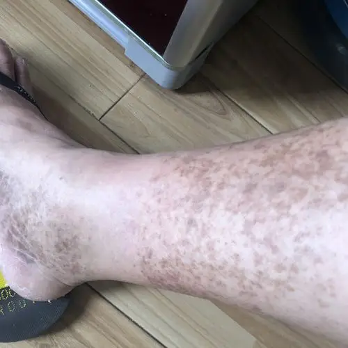 腿上脚面上长黑斑怎么治疗