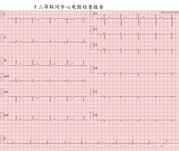 患者,女,40,胸闷一天.心电如下