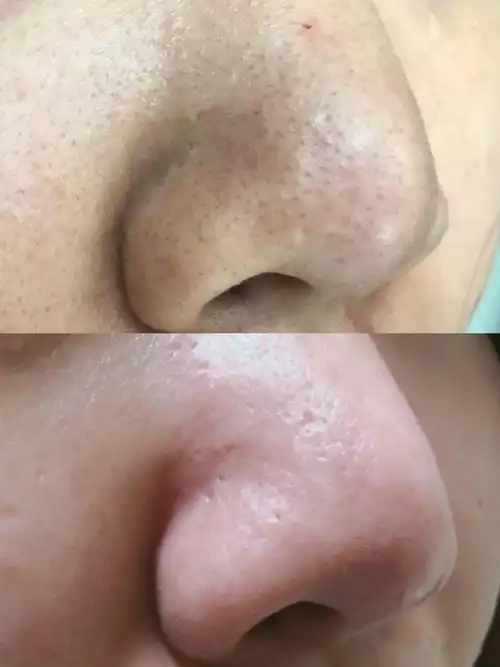 黑头放大1000倍图片(有哪些去鼻子黑头的方法) - 赤虎壹号