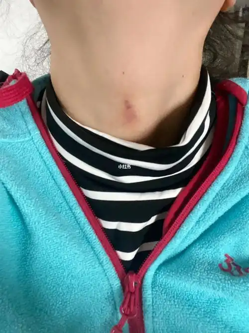 我91了后的第三天开始喉咙巨痛,吞咽口水都疼痛,但是没有吞刀片那么