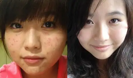 祛痘对比照片大图_百度图片搜索