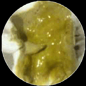 12,油性大便(大便颜色发亮)