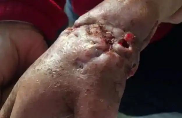 左手骨髓炎案例