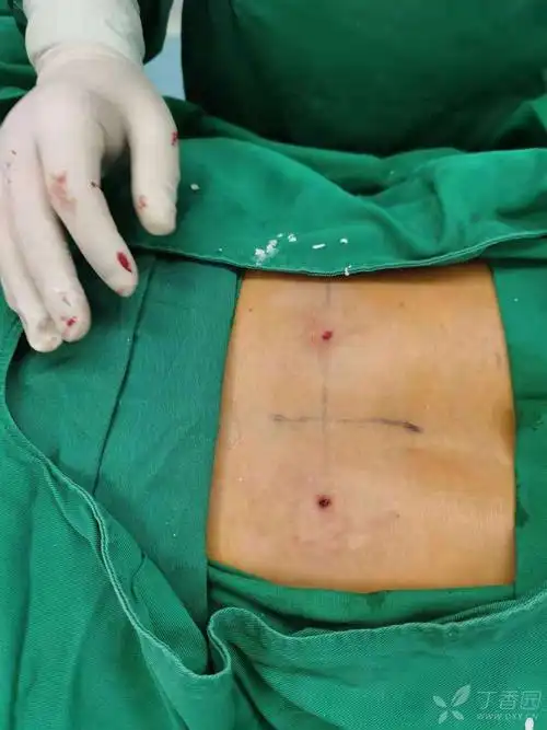 胸椎骨折椎体成形术兴平市中医医院骨伤科李亚先