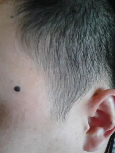 这两年长了个黑痣,不知道是什么大家给看看是什么,怎么处理?