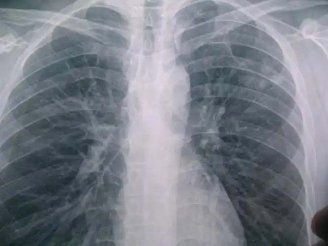 求助!左上肺继发性肺结核(大部分硬结纤维化)
