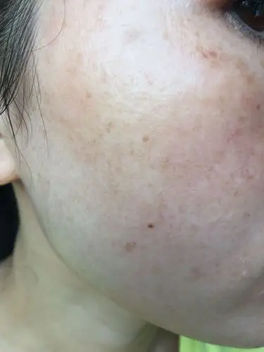 好烦恼,敏感性肌肤,脸上这黑色素怎么去除?有五年了.