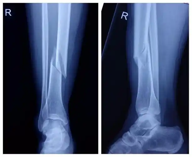 小切口微创治疗胫骨下段骨折