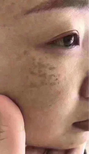 真皮斑第一期:脸颊 真皮斑第二期:太阳穴 真皮斑第_圈子-新氧美容整形