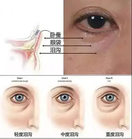 2000元和7800元的去眼袋手术有多大区别?3个答案颠覆三观
