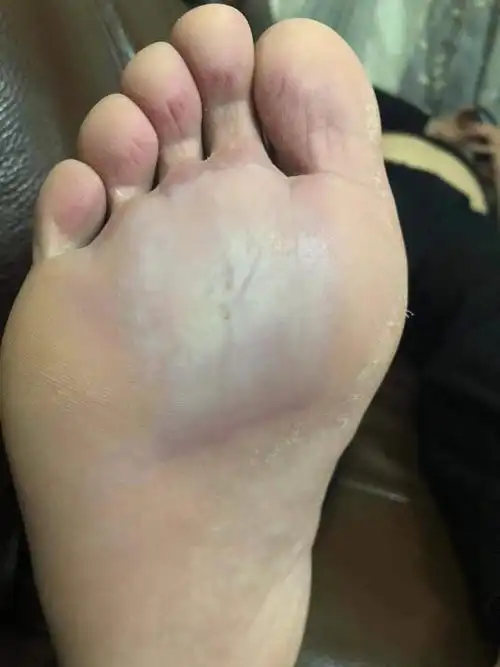 有没有医生看看我脚底怎么了,感觉又点发炎,走路有点疼?