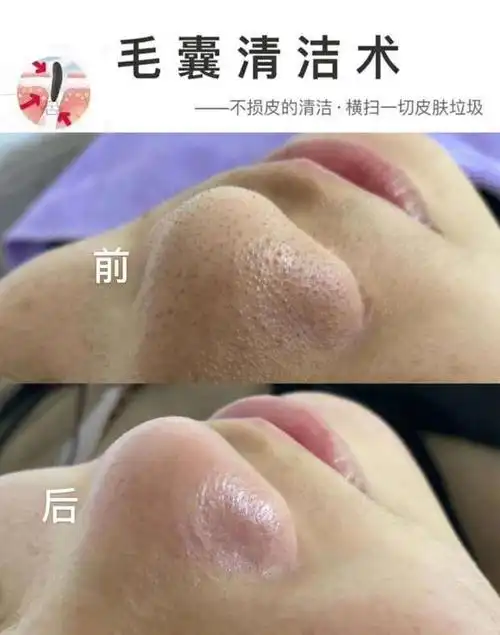 美容院黑头毛囊清洁术毛孔洗澡净化霜深层去角质黑头排污按摩膏