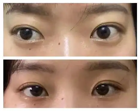 眼球突出矫正术价格(长期加班) - 价格百科