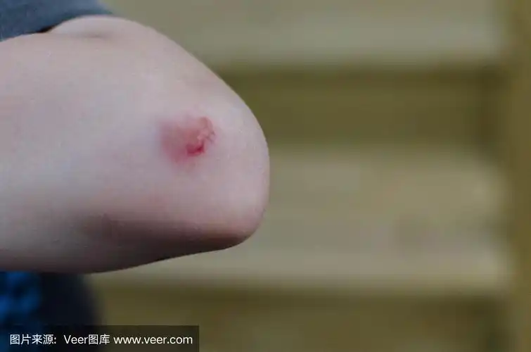 小孩的胳膊肘破了