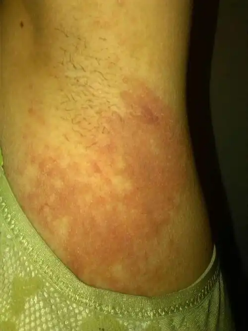 红色疹子,痒,不知道什么原因引起的,地方门诊大夫瞟了一眼就说是皮炎