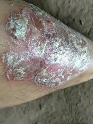 是什么癣么?感染的地方越来越大了,又不想去医