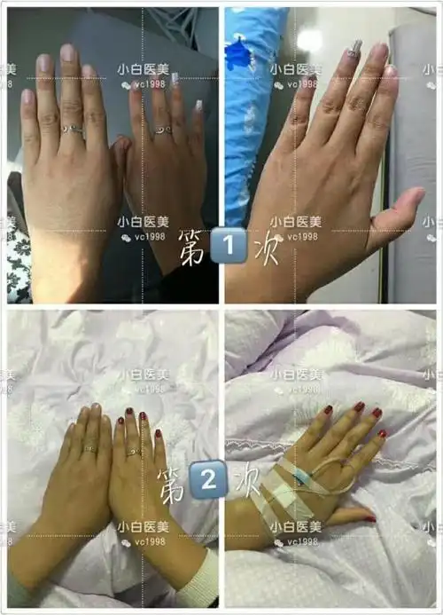 美白针效果图前后对比,天生黑南光贵妇美白针对比