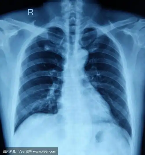 胸部x光图像