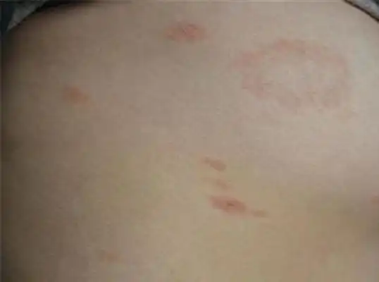 花斑癣早期图片40