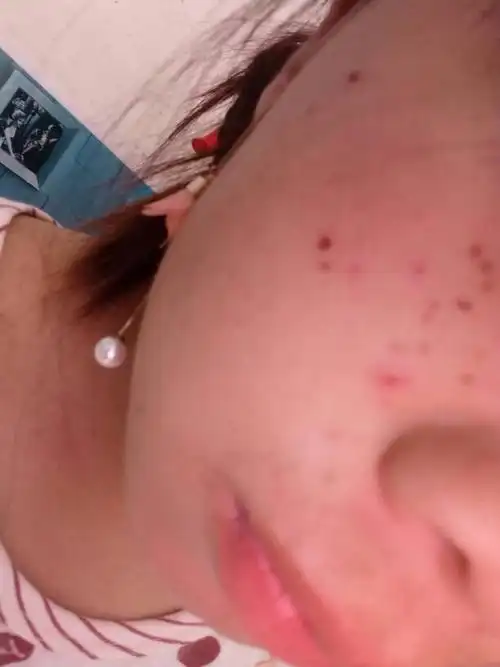 脸上结痂了不小心扣掉了,成这样子,请问后面会结疤吗,用什么药修复