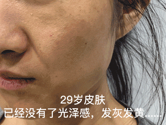 胃经老化,皮肤代谢差:加重松弛发黄,眼袋下垂,黑眼圈.