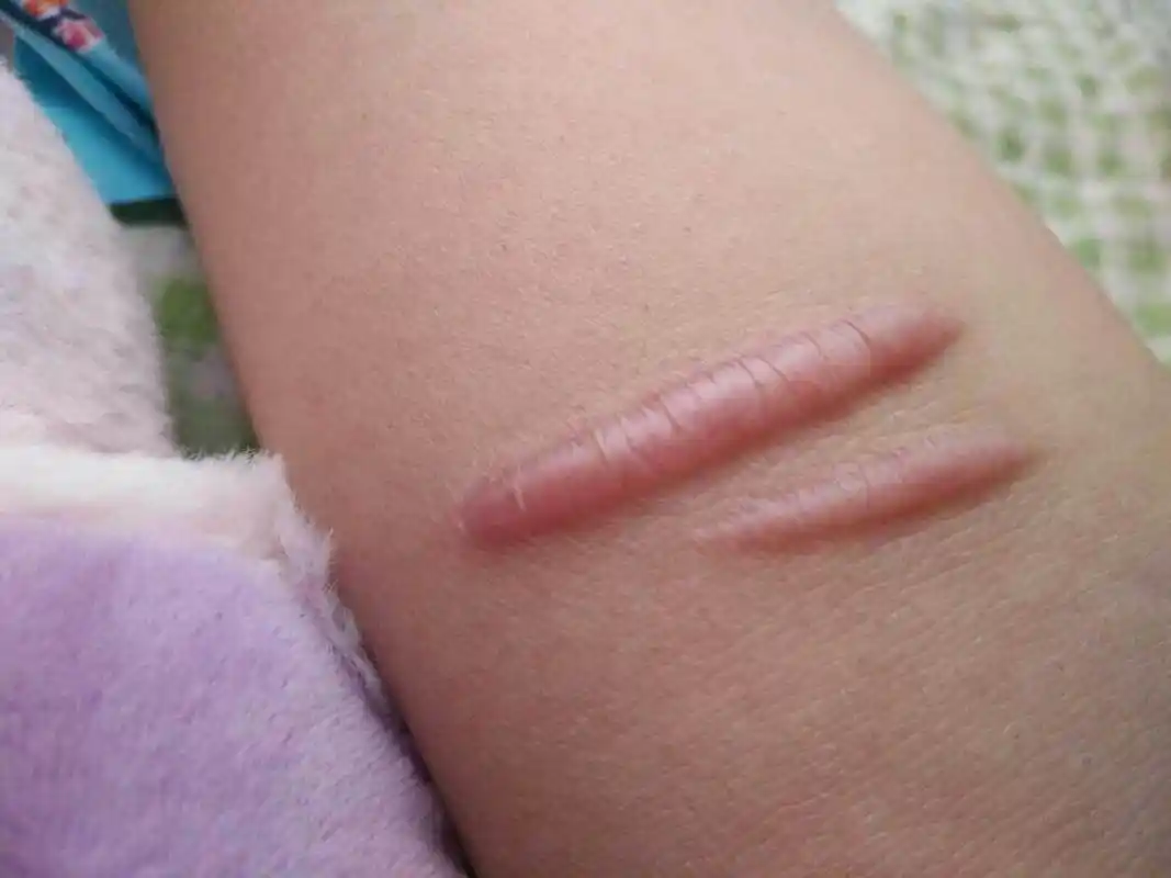 疤痕增生# #佛山疤痕医院# 一般来说,点阵激光是能治疗凸起疤痕的