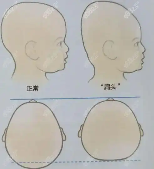 韩国后脑勺整形是真的吗?