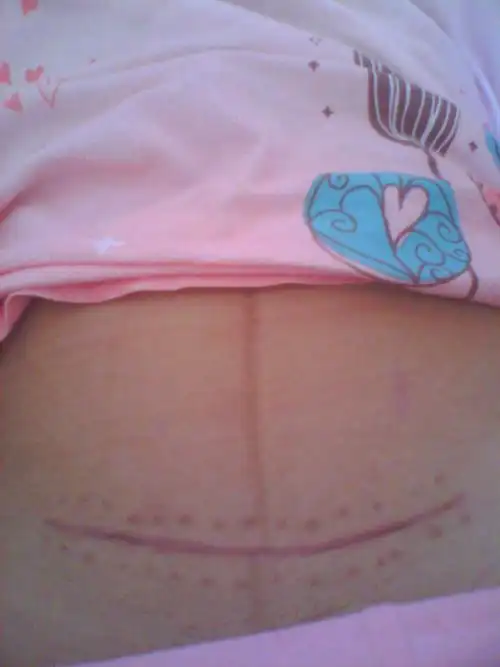 9月剖腹产的宝妈,你的伤口恢复的怎么样了?上图片