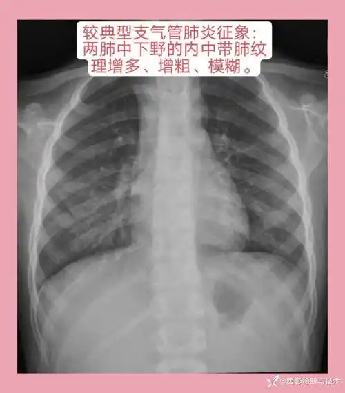 丁香园论坛>影像核医学>帖子详情>间质性肺炎x线表现:两肺门及中下