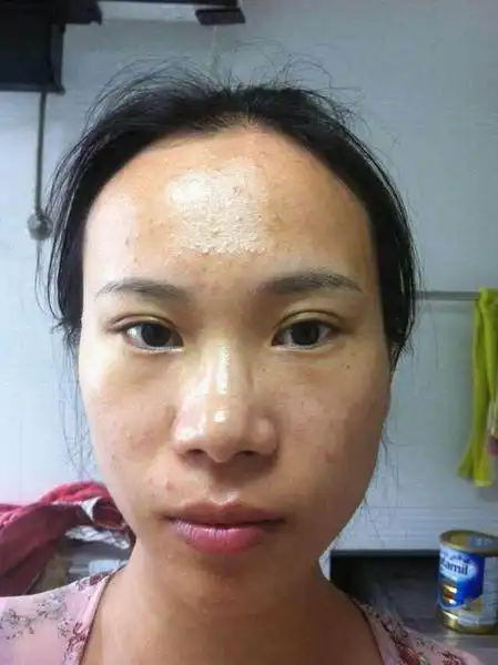 生完宝宝后皮肤暗黄 痘痘还一直长个不停皮肤粗糙 老公说摸起来都没有