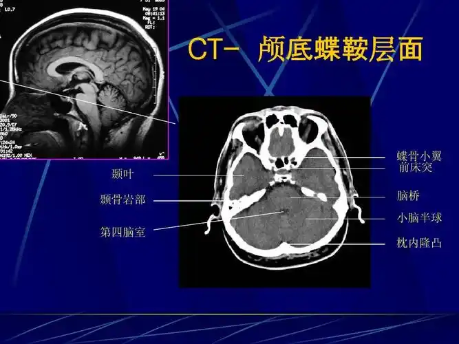 cns正常及异常影像改变 ctct- 颅 层 颞叶 颞骨岩部 第四脑室 蝶骨