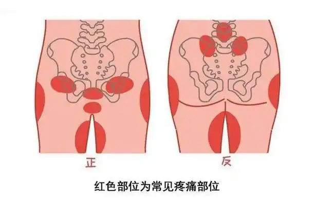 耻骨在哪里疼怎么办耻骨疼是指哪个部位