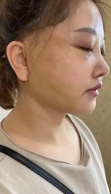 78迷你拉皮术后第十六天恢复