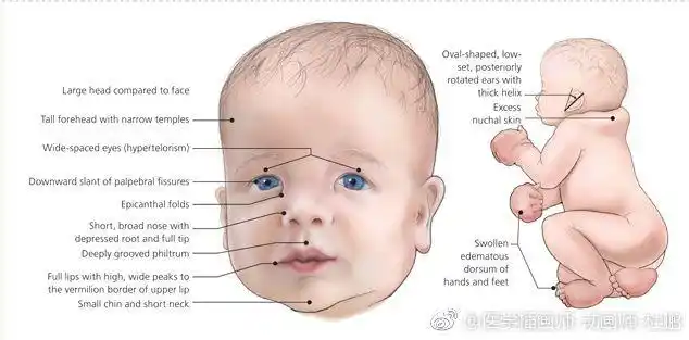 努南综合征(noonan syndrome)本征属原发性睾丸功能减退症的一个类型