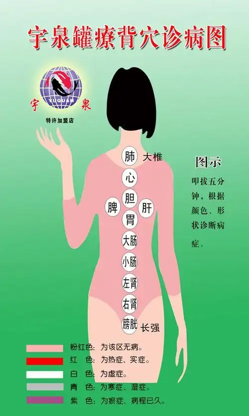 背部全息罐诊罐疗 - 罐疗罐诊理疗康复中心 - 罐诊罐疗理疗康复中心