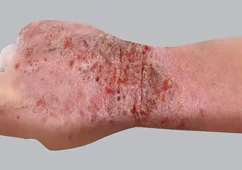 严重的大人湿疹图片渗液症状