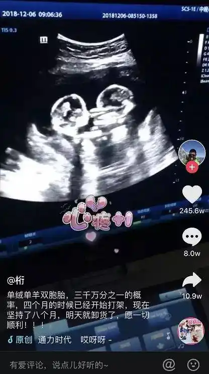 这段双胞胎在妈妈肚子里打架的视频,火了!