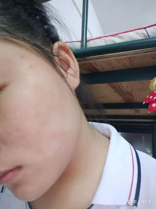 我一个女生脸上长花斑癣可怎么办阿