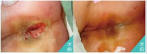 肛瘘手术前面对比的图片