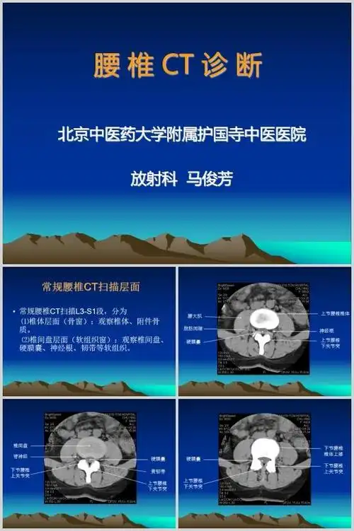 腰椎ct诊断大全(ppt 32页)
